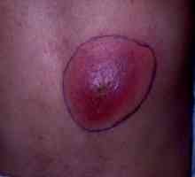 Kožní absces: Prostředky pro léčbu, příčiny, příznaky, příznaky