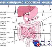 Vliv syndromu krátkého střeva (SPV) na gastrointestinální trakt