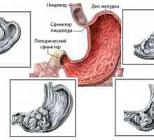 Adenokarcinom (rakovina), žaludeční