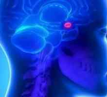 Adenom hypofýzy v mozku: symptomech, léčení a odstranění, předpověď, efekty, příčiny, příznaky