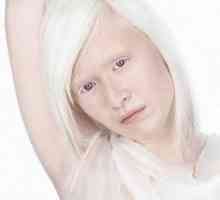 Albinismus u lidí, oční