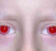 Albinismus u člověka: symptomy, příčiny, příznaky, léčba