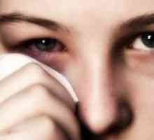 Alergický zánět spojivek: léčba, příznaky, příčiny, příznaky