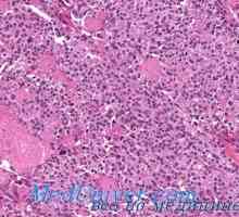 Rakovina štítné žlázy amyloid. Scirrhous rakoviny štítné žlázy
