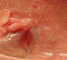 Anal polyp - příznaky, příčiny vzniku, zejména ošetření