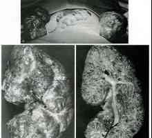 Vývojové stav ledvin abnormality a. Cystická renální anomálie