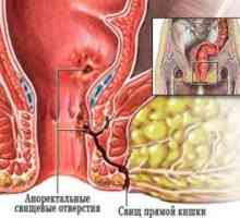 Anorektální absces: Prostředky pro léčbu, symptomy, příčiny