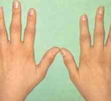 Artritida metacarpal falanga kloub ruky: léčba, příznaky, znaky, příčiny