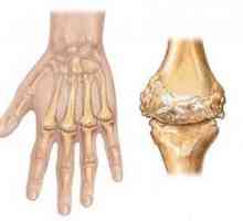 Zánětlivé artritidy (infekční a infekční-alergické)