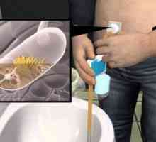 Aspireassist: chirurgický implantát k léčbě obezity