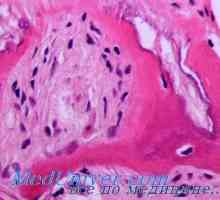 Ateroskleróza v pozadí inzulínové rezistence. Tuku metabolismus u diabetu a pre-diabetické stavu