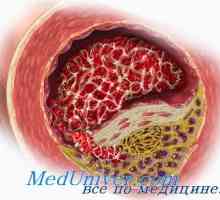Ateroskleróza v menopauze a menopauza. Vliv testosteronu na arteriosklerózu androgenů