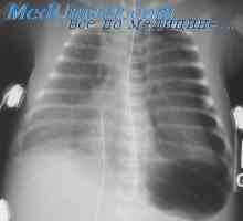 Barotrauma plic při dekompresi. Patogeneze plicního barotraumatu