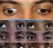 Graefe choroba. Vrozené oční apraxie nebo Cogan syndrom