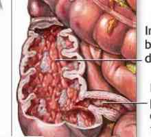 Toto onemocnění tenkého střeva Crohnova
