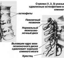 Bolesti zad. spondylarthrosis