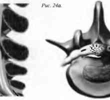 Bolest zad herniated pulpózního jádra (disc kýla)