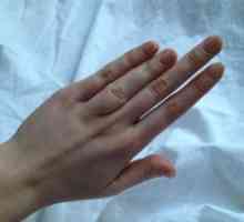 Brachydaktylie palec: příčiny, léčba, příznaky, příznaky