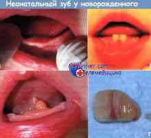 Neonatální zub novorozené příčiny, diagnostika
