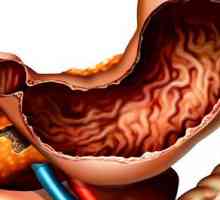 Co je chronický zánět žaludku anatsidny, její příznaky a léčba