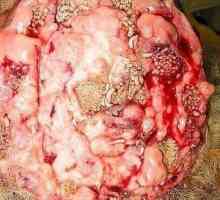 Mozková cysticerkóza