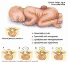 Neurální trubice vady u dětí: encephalocele, meningomyelocoele