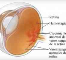 Neproliferativní diabetická retinopatie a diabetická retinopatie (NPDR)