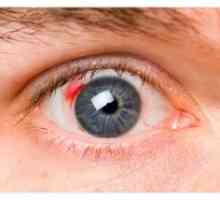 Diabetická retinopatie: příznaky, léčba, jeviště, komplikace