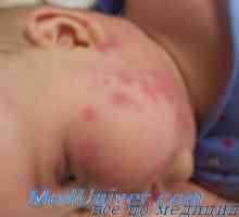 Diagnostika alergie a jiné nežádoucí účinky léčivých přípravků u dětí