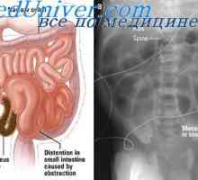 Gastrointestinální obstrukce. Plyny v nadýmání gastrointestinálního traktu