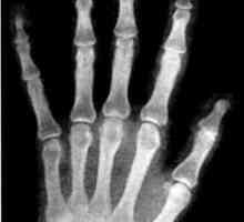 Diagnóza revmatoidní artritidy. diagnostická kritéria