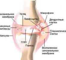 Dysenterický (posledizenteriyny) artritida