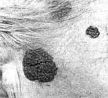 Nezhoubné kožní nádory hlavy a krku: pigmentované névus