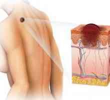 Nezhoubné kožní nádory: typy, klasifikace, léčba, symptomy