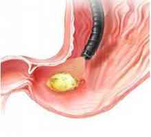 EGD v diagnostice erozivní gastritida