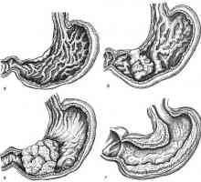 Formy rakoviny žaludku, raznovvidnosti syndromů, velikost, lokalizace