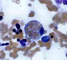 Hemofagocytující lymfohistiocytóza: léčba, příčiny, prognózu