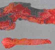 Hemoragické nekrotizující pankreatitida a akutní forma