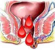 Hemoroidy během menstruace, proč se zhoršila před nimi?