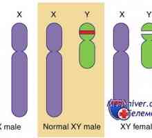 Genetické poruchy pohlavních žláz. Geny sry, WT1 a syndromy Fraser a Denis-dresha