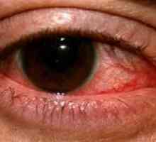 Herpetickou keratitis očí: léčba, prevence, příznaky, příčiny