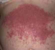 Dermatitis herpetiformis: příznaky, léčba