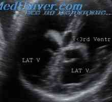 Hyperechogenní inkluze v komorách. Placenta jako ementál