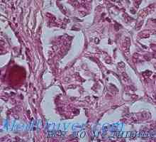 Hyperparathyroid generalizované vláknitý osteodystrofie (von Recklinghausenova onemocnění)…