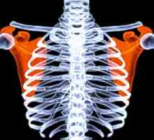 Hyperparathyroid osteodystrofie: Léčba