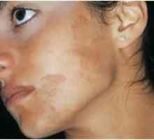 Hyperpigmentace kůže: léčba, příčiny, prevence