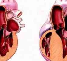 Hypertrofické kardiomyopatie: léčba, symptomy