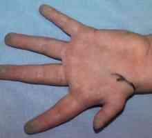 Hypoplazie prvních prstů