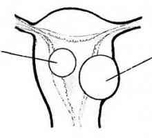 Hysteroskopie v diagnostice a léčbě děložních fibroidů