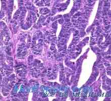 Histologie vaječníků se syndromem polycystických. Tekakletochnaya reakce